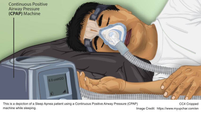 This is a depiction of a Sleep Apnea patient using a Continuous Positive Airway Pressure (CPAP)